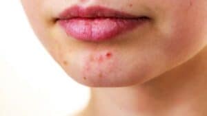 eliminar acne y cicatrices