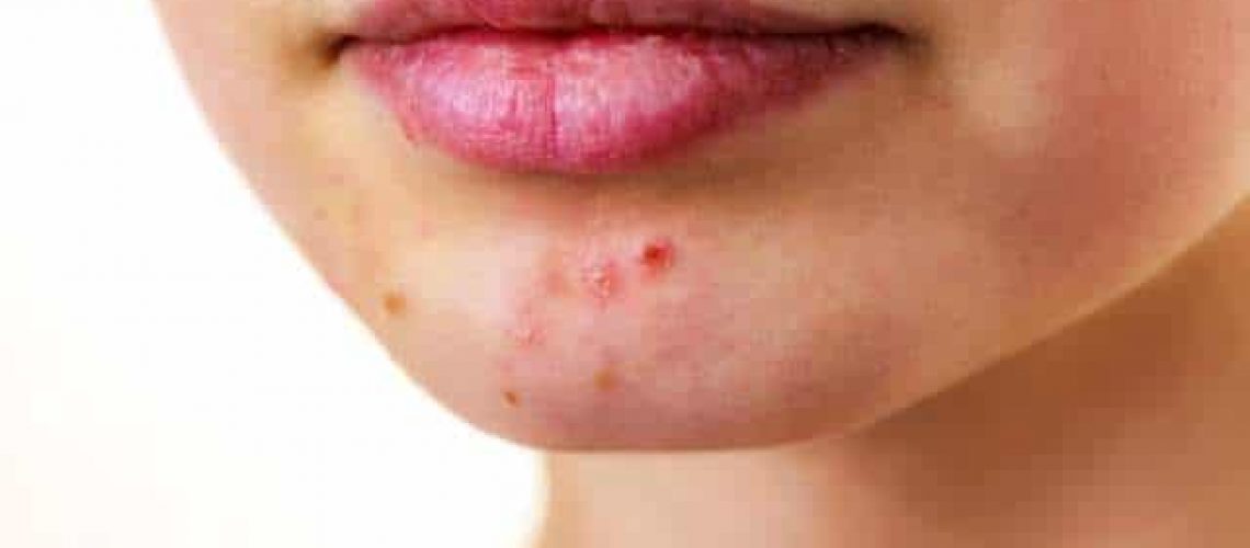 eliminar acne y cicatrices